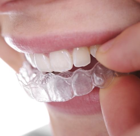 Close up of person placing a ClearCorrect aligner over their teeth