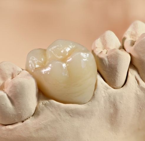 Dental crown covering a tooth in a model of the mouth