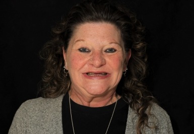 Smile with slightly gapped and discolored teeth