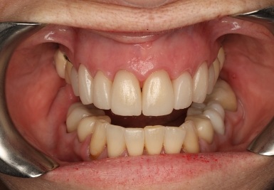 Smile with white and evenly spaced teeth