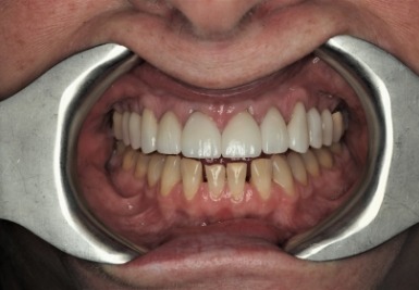 Smile with white and evenly spaced teeth