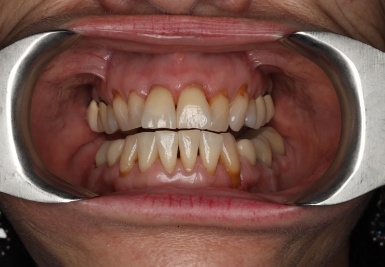 Smile with slightly gapped and discolored teeth