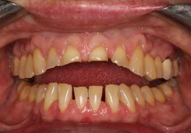 Smile with slightly gapped and discolored teeth
