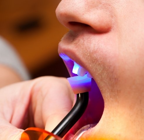 Dental patient receiving cosmetic bonding on front upper tooth