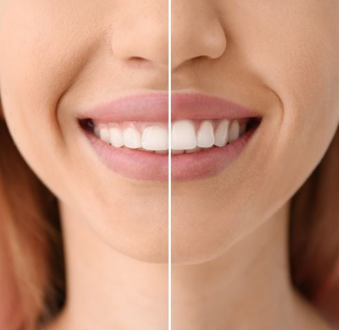 Close up of smile before and after gummy smile correction