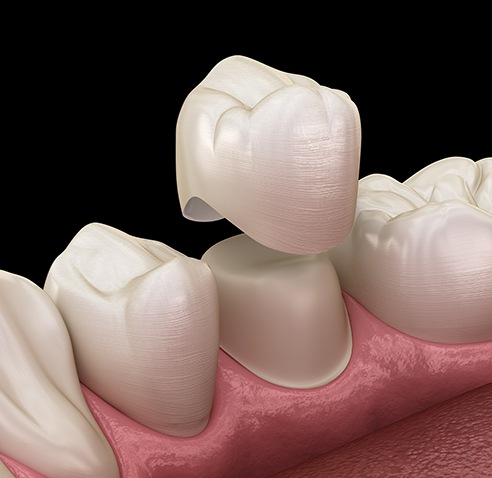 a 3D illustration showing a dental crown being placed