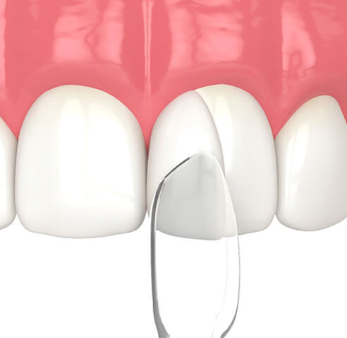Illustration of composite resin being molded onto a tooth