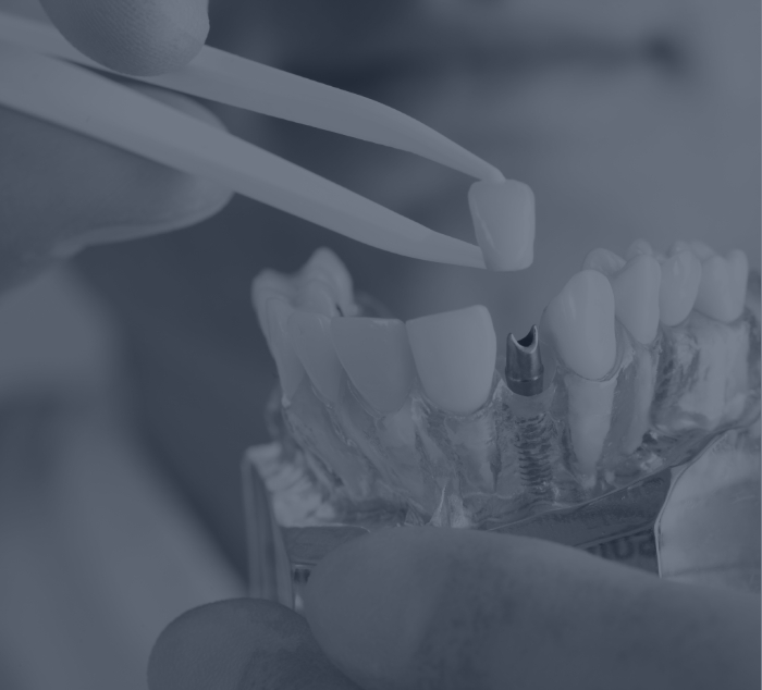 Dentist placing a crown on a model of a dental implant in Parker