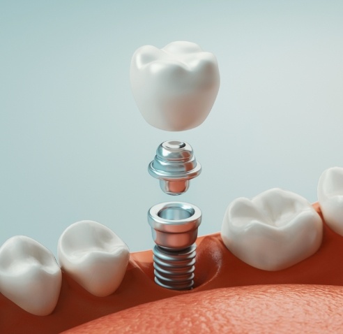 Illustrated dental crown being fitted onto a dental implant