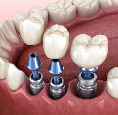 Illustration of three dental crowns being placed onto three dental implants