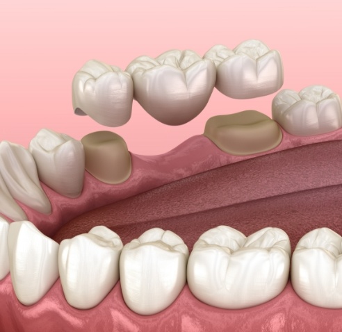 Illustrated dental bridge replacing a missing tooth