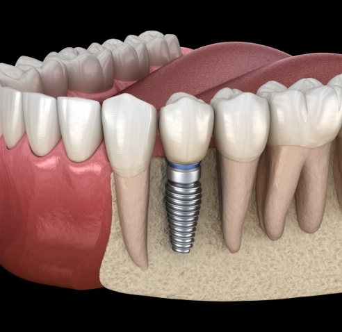 Illustrated dental implant with dental crown replacing a missing tooth