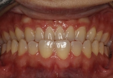 Smile with white and evenly spaced teeth