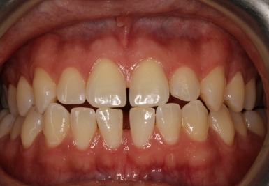 Smile with slightly gapped and discolored teeth