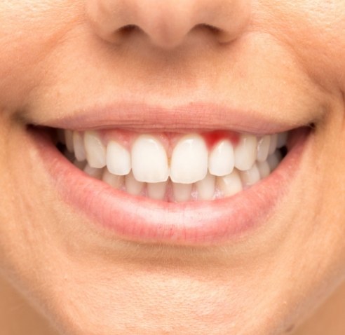 Close up of smile with red spot in the gums