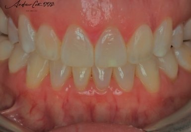 Smile with white and evenly spaced teeth