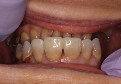 Smile with white and evenly spaced teeth