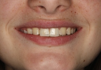 Smile with white and evenly spaced teeth