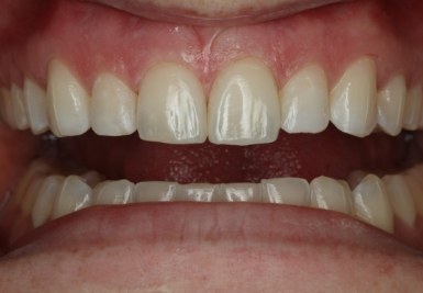 Smile with white and evenly spaced teeth
