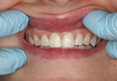 Smile with white and evenly spaced teeth