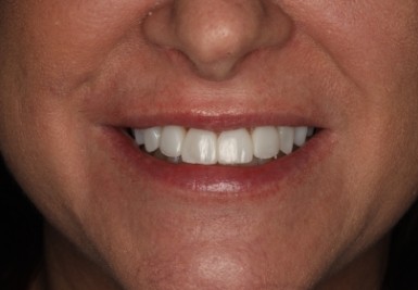 Smile with white and evenly spaced teeth
