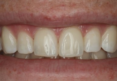 Smile with white and evenly spaced teeth