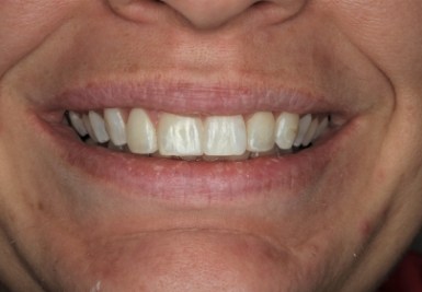 Smile with white and evenly spaced teeth