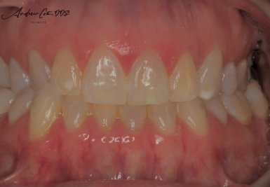 Smile with slightly gapped and discolored teeth