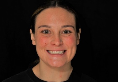 Smile with slightly gapped and discolored teeth