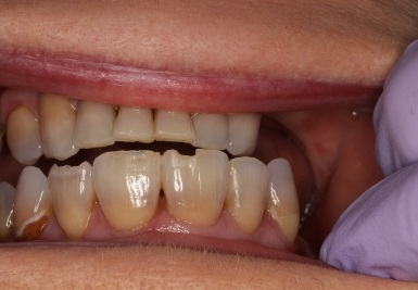 Smile with slightly gapped and discolored teeth