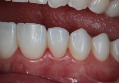 Smile with white and evenly spaced teeth