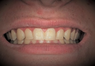 Smile with slightly gapped and discolored teeth