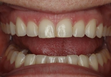Smile with slightly gapped and discolored teeth