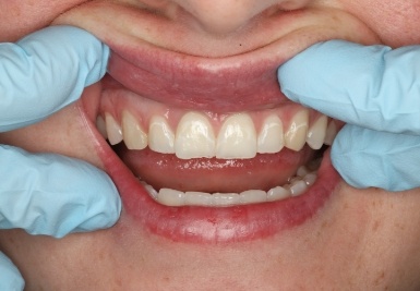 Smile with slightly gapped and discolored teeth