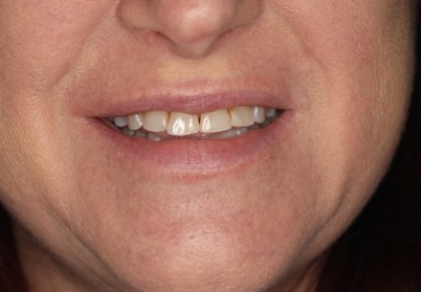 Smile with slightly gapped and discolored teeth