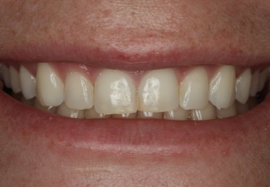Smile with slightly gapped and discolored teeth