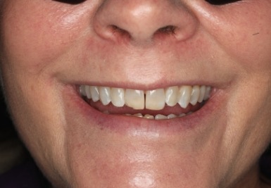 Smile with slightly gapped and discolored teeth